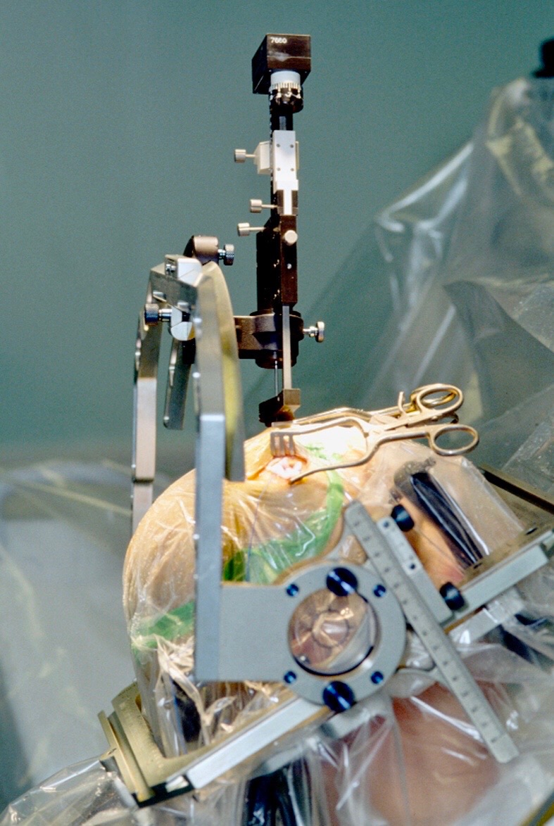 Deep Brain Stimulation Surgery For Essential Tremors